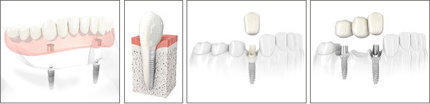 Dental Implants Jackson Mississippi