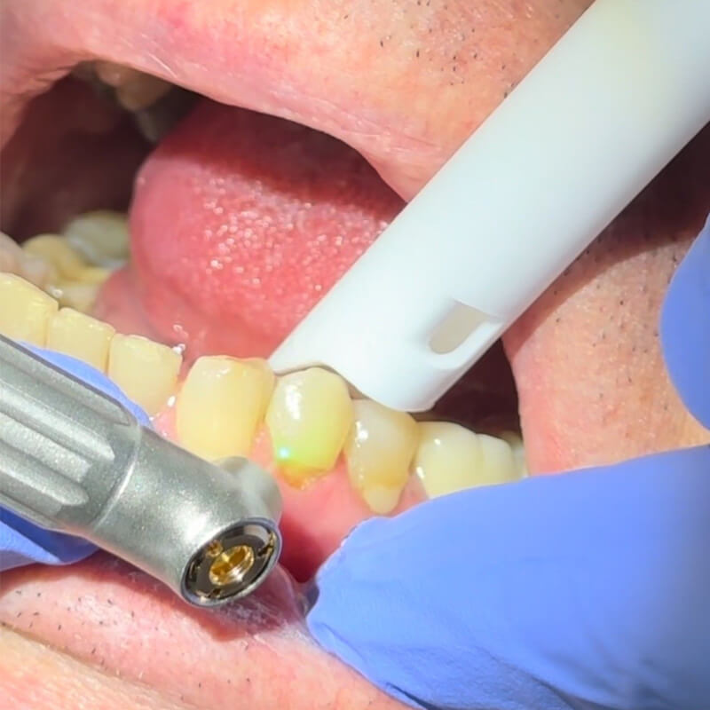 Laser Dentistry Recontouring
