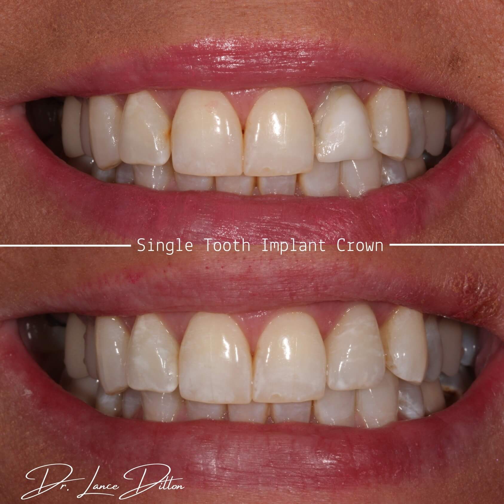 Dental Implants Madison MS