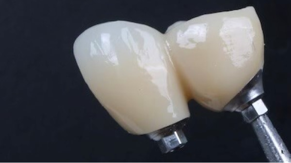 Implant Crown